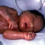 Пленка коричнево-желтого оттенка у младенца